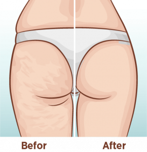 Backside view of a women before and after a cellulite remove treatment