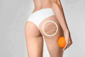 Skin with cellulite is compared to an orange peel
